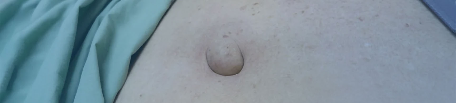 Chirurgie de la paroi abdominale